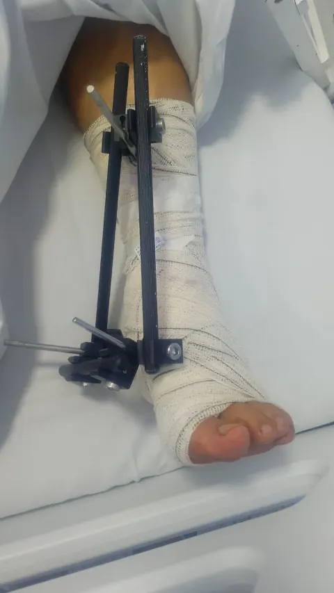 Idoso sofre fratura na perna após colidir com moto elétrica em Santos.
